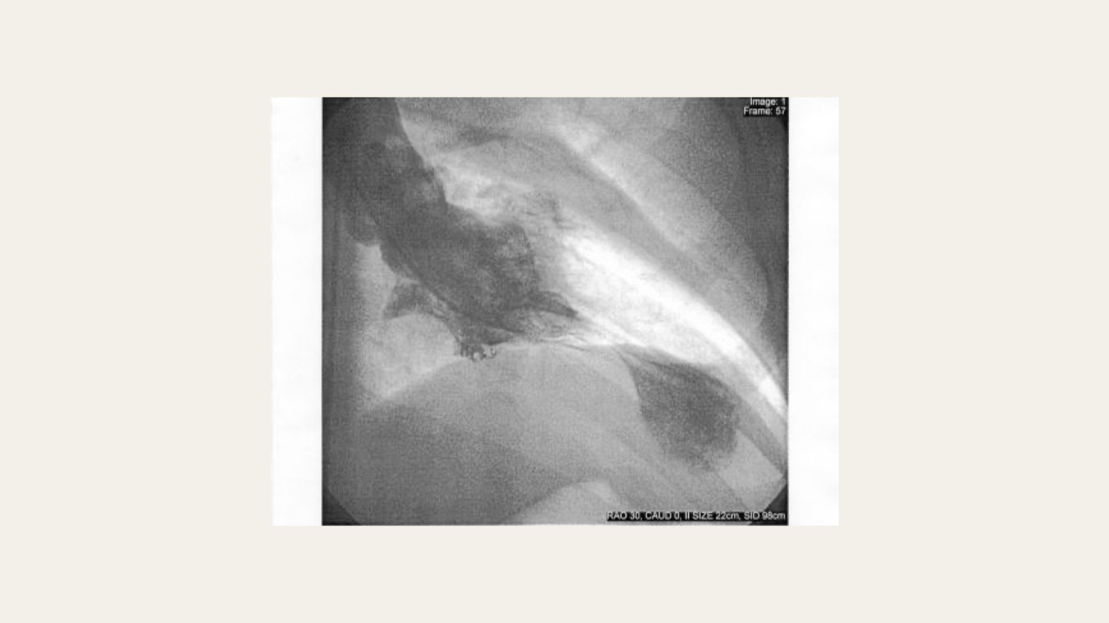 A real left-ventricular angiogram of a patient during an episode of takotsubo syndrome: a grayscale X-ray image in which the contrast-filled left ventricle shows its lower tip ballooned outward while the neck narrows, the shape that gives the condition its name